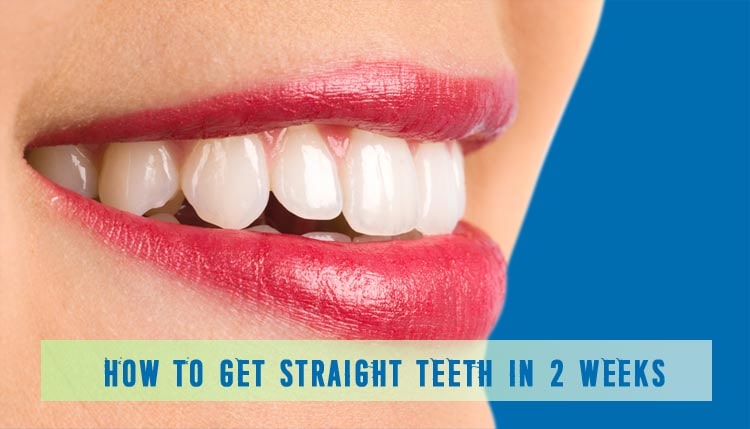 How to get straight teeth in 2 weeks