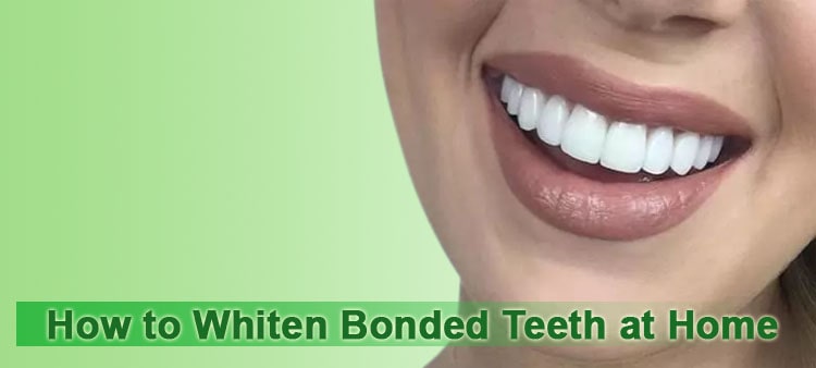 How to whiten bonded teeth at home